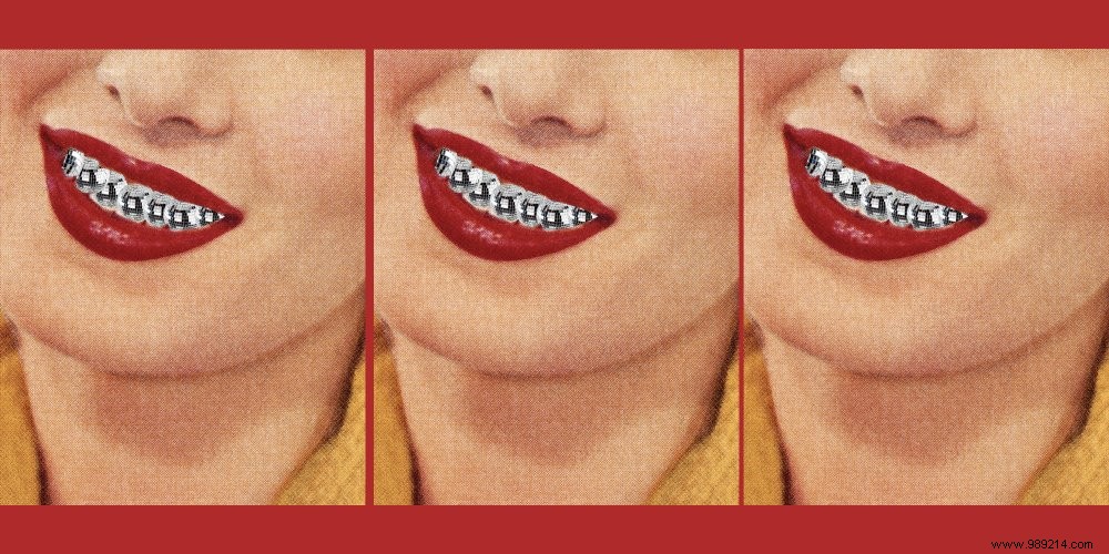 Dental Veneers: Risks of This Irreversible Cosmetic Procedure, Expert Insights