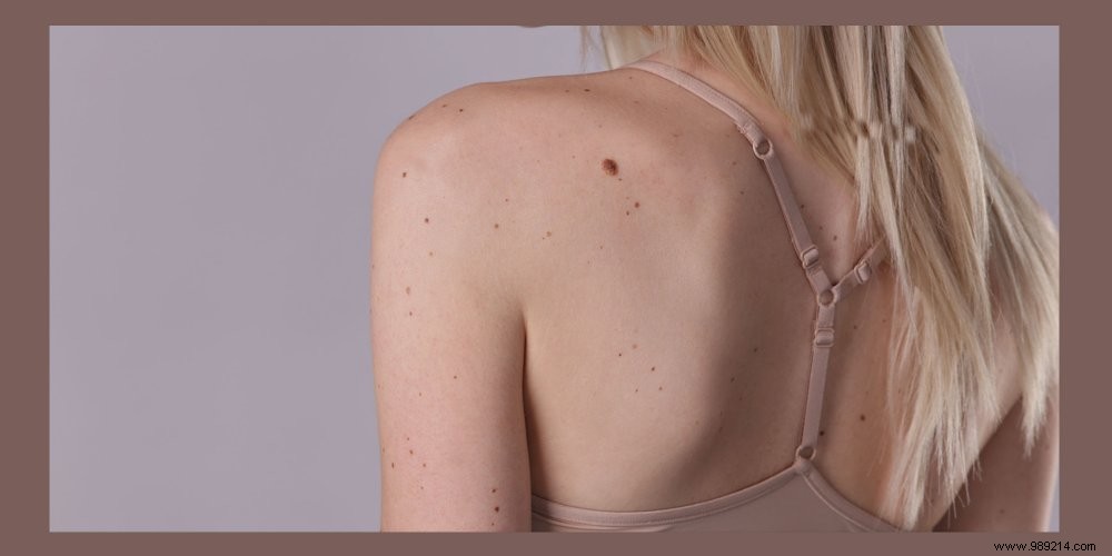 How to Check Your Moles for Skin Cancer: Dermatologist s Essential Guide