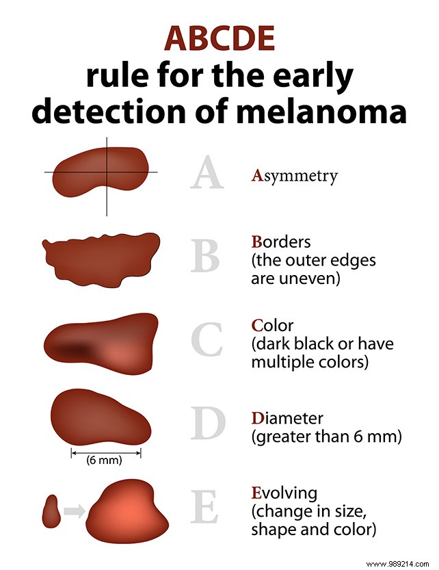 How to Check Your Moles for Skin Cancer: Dermatologist s Essential Guide
