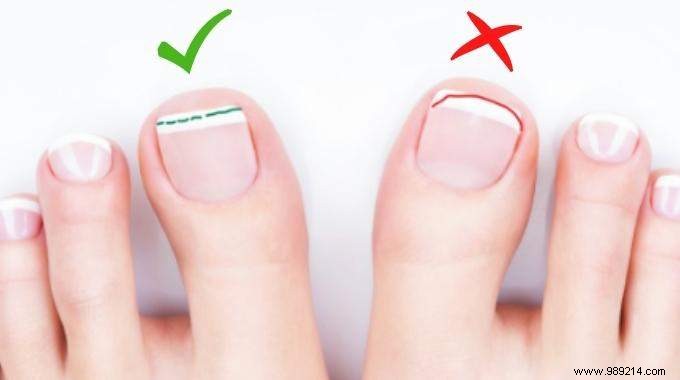 Podiatrist-Approved Technique: Cut Toenails Square to Prevent Painful Ingrowns