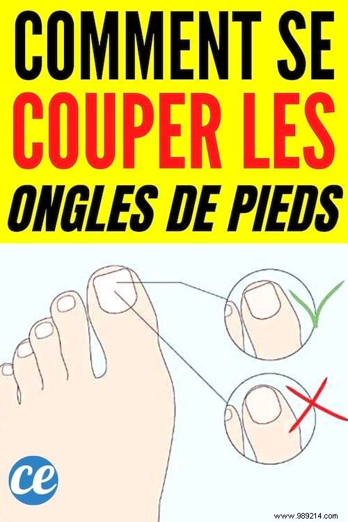 Podiatrist-Approved Technique: Cut Toenails Square to Prevent Painful Ingrowns