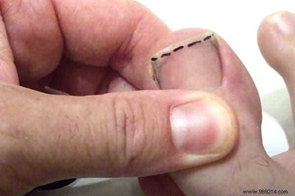 Podiatrist-Approved Technique: Cut Toenails Square to Prevent Painful Ingrowns