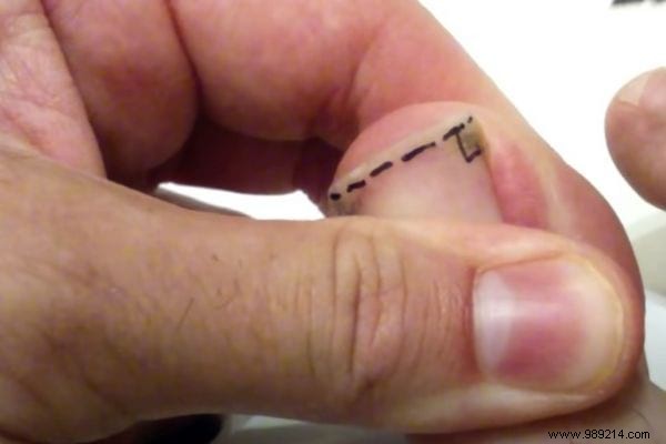 Podiatrist-Approved Technique: Cut Toenails Square to Prevent Painful Ingrowns