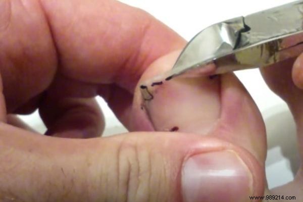Podiatrist-Approved Technique: Cut Toenails Square to Prevent Painful Ingrowns