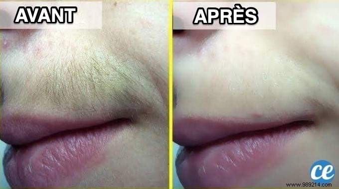 10 Proven Tips for Upper Lip Hair Removal: Painless and Effective Methods