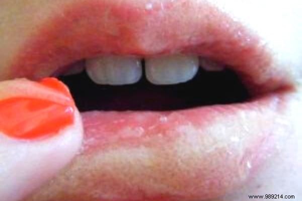 Lighten Tobacco-Stained Lips: 3 Proven Natural Remedies for Results in 1 Week