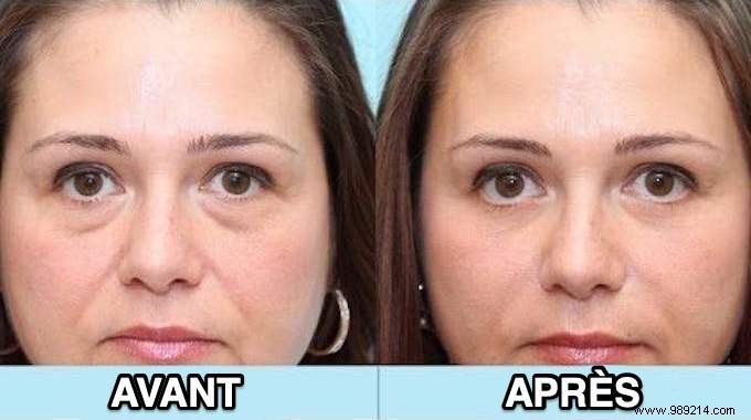 Quick Salt Water Compress: Deflate Morning Puffy Eyes in Minutes