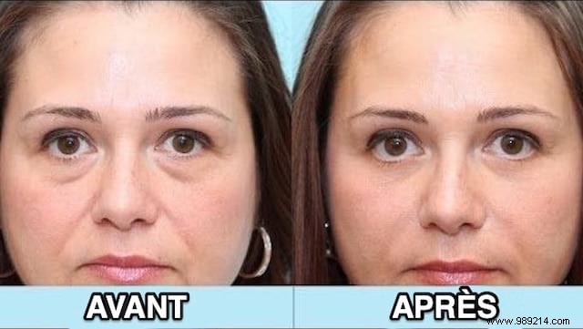 Quick Salt Water Compress: Deflate Morning Puffy Eyes in Minutes