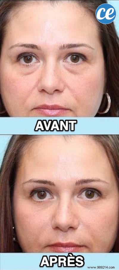 Quick Salt Water Compress: Deflate Morning Puffy Eyes in Minutes