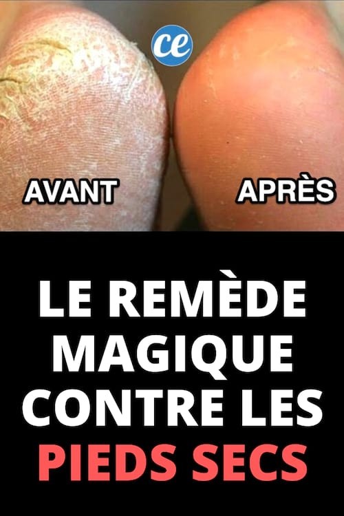 Natural Homemade Foot Soak: Banish Dry, Cracked Heels in 3 Simple Steps