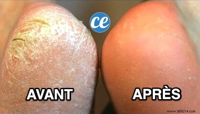 Natural Homemade Foot Soak: Banish Dry, Cracked Heels in 3 Simple Steps