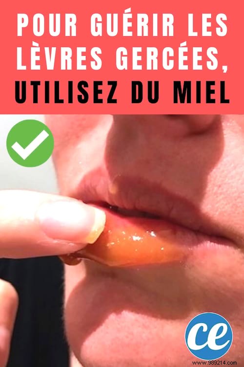 Heal Chapped Lips Overnight: A Proven Natural Honey Remedy