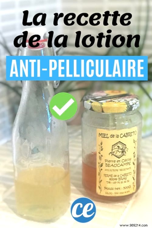 Eliminate Dandruff Naturally: Dermatologist-Recommended Honey Lotion Recipe