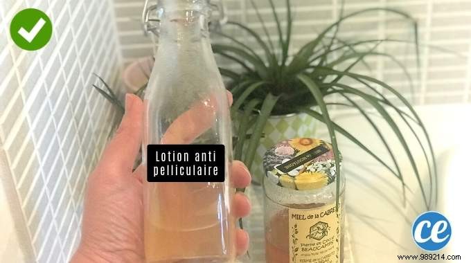 Eliminate Dandruff Naturally: Dermatologist-Recommended Honey Lotion Recipe