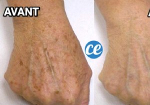 Fade Age Spots Naturally: Grandma s Time-Tested Apple Cider Vinegar Remedy