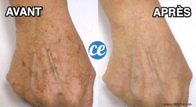 Fade Age Spots Naturally: Grandma s Time-Tested Apple Cider Vinegar Remedy