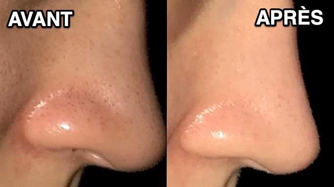 Banish Blackheads Effectively: Proven Baking Soda Exfoliating Treatment