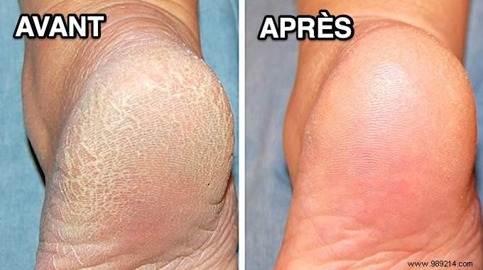 3 Proven Natural Remedies for Dry, Cracked, and Swollen Feet