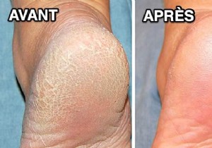 3 Proven Natural Remedies for Dry, Cracked, and Swollen Feet