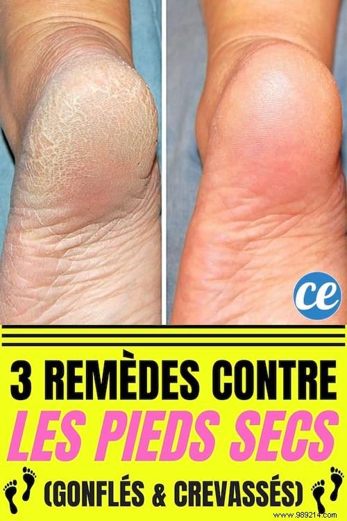 3 Proven Natural Remedies for Dry, Cracked, and Swollen Feet
