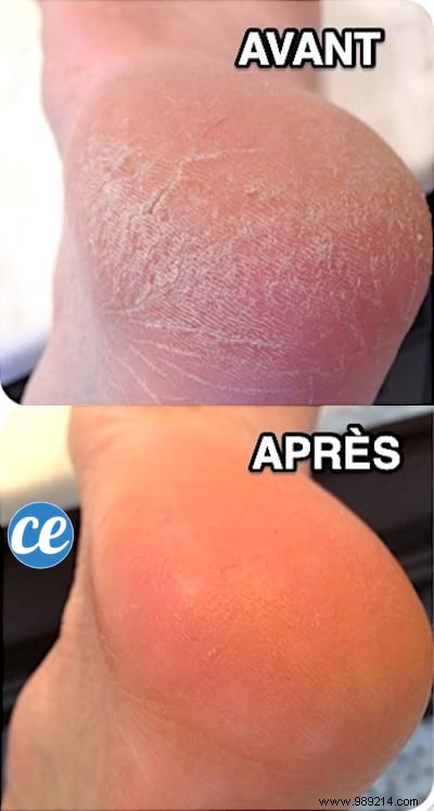 7 Proven Natural Remedies for Soft, Smooth Feet