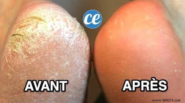 7 Proven Natural Remedies for Soft, Smooth Feet