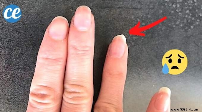 Strengthen Brittle Nails Naturally: The Proven Magnesium Chloride Remedy