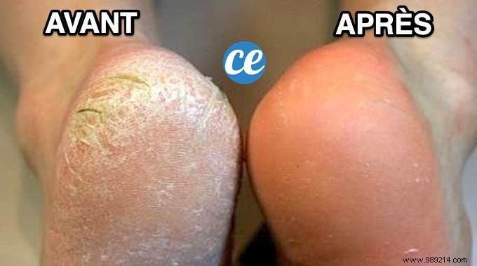 Grandma s Proven Lemon Poultice: Naturally Remove Stubborn Foot Calluses Overnight