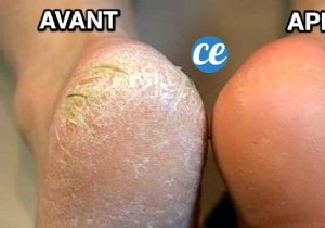 Grandma s Proven Lemon Poultice: Naturally Remove Stubborn Foot Calluses Overnight