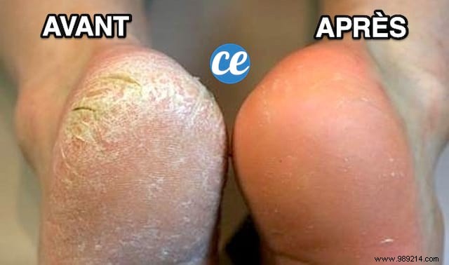 Grandma s Proven Lemon Poultice: Naturally Remove Stubborn Foot Calluses Overnight