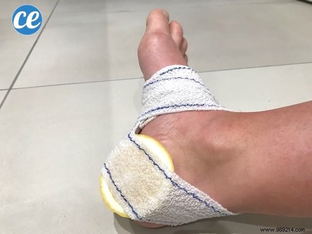 Grandma s Proven Lemon Poultice: Naturally Remove Stubborn Foot Calluses Overnight