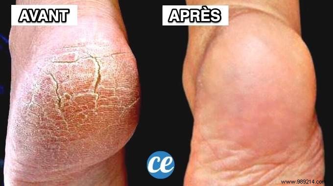 9 Proven Natural Remedies to Heal Cracked Heels Fast