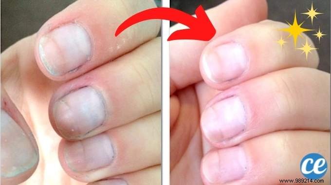 How to Instantly Whiten Yellowed Nails with Baking Soda: A Proven Natural Remedy