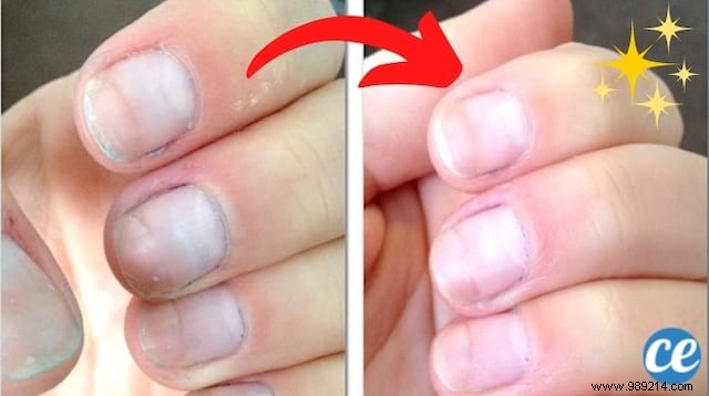 How to Instantly Whiten Yellowed Nails with Baking Soda: A Proven Natural Remedy