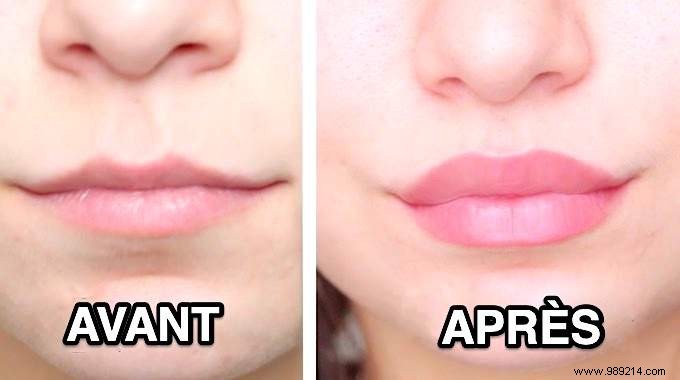 12 Natural Ways to Achieve Fuller Lips Without Surgery or Injections