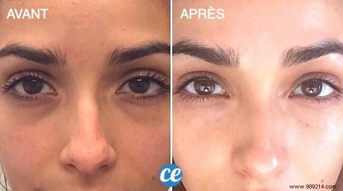 11 Proven Grandma s Remedies to Erase Dark Circles Under Eyes Quickly