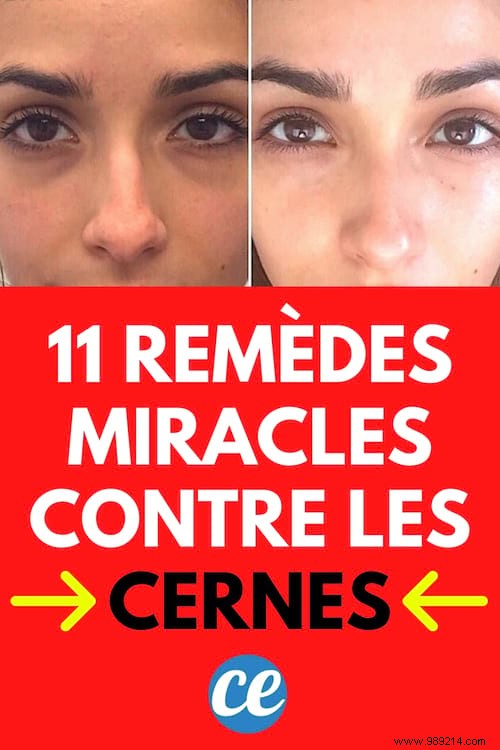 11 Proven Grandma s Remedies to Erase Dark Circles Under Eyes Quickly
