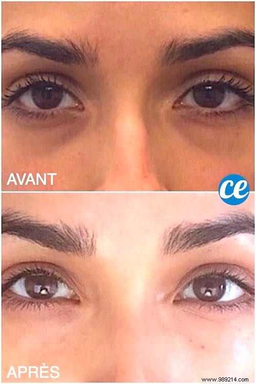 11 Proven Grandma s Remedies to Erase Dark Circles Under Eyes Quickly