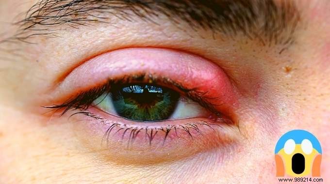 12 Proven Natural Remedies to Eliminate Styes Quickly and Safely
