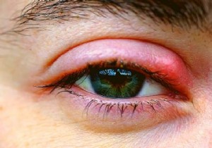 12 Proven Natural Remedies to Eliminate Styes Quickly and Safely