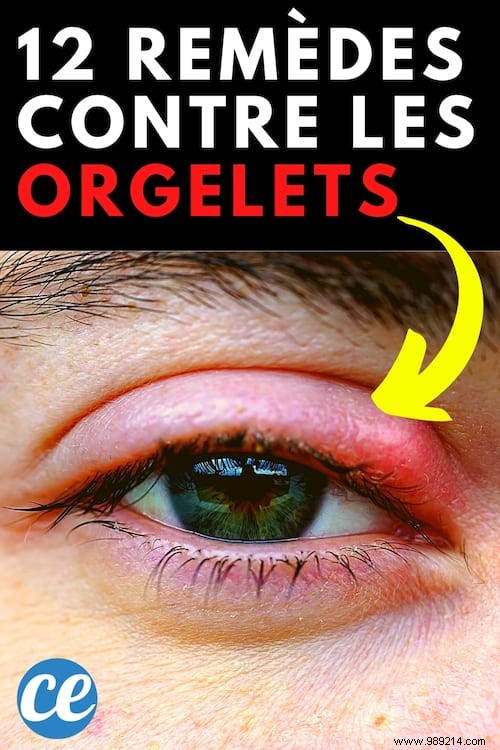 12 Proven Natural Remedies to Eliminate Styes Quickly and Safely