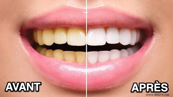 Natural Teeth Whitening in Just 1 Day: My Baking Soda and Hydrogen Peroxide Method