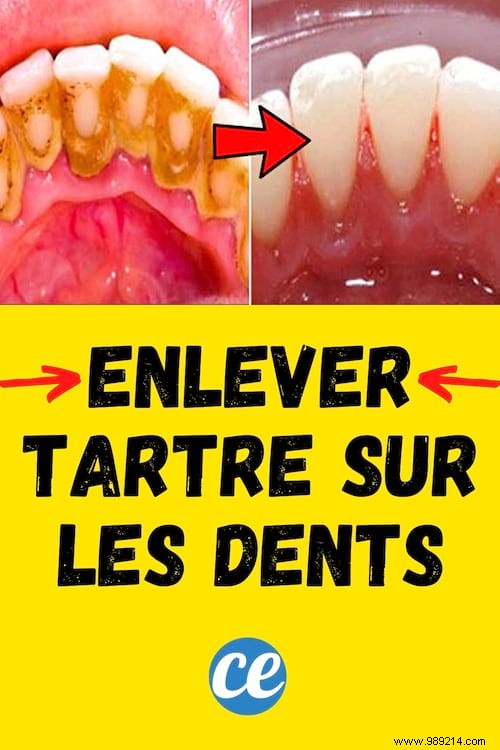 3 Proven Natural Ways to Remove Dental Tartar at Home