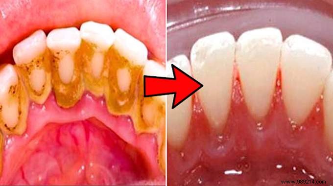 3 Proven Natural Ways to Remove Dental Tartar at Home