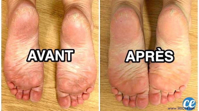 Achieve Baby-Soft Feet with This Proven Baking Soda Treatment