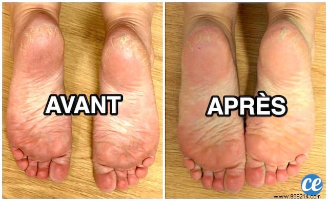Achieve Baby-Soft Feet with This Proven Baking Soda Treatment