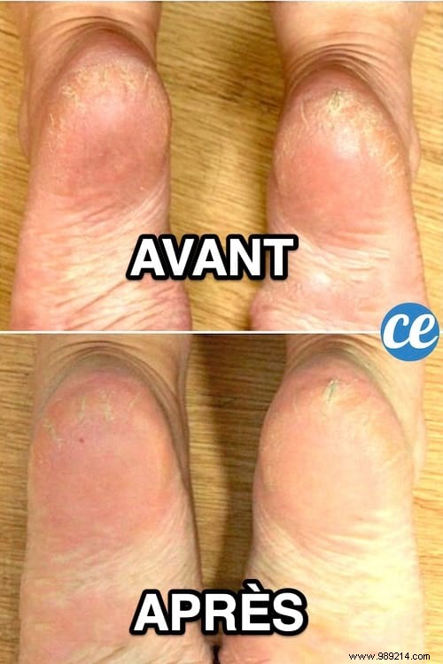 Achieve Baby-Soft Feet with This Proven Baking Soda Treatment