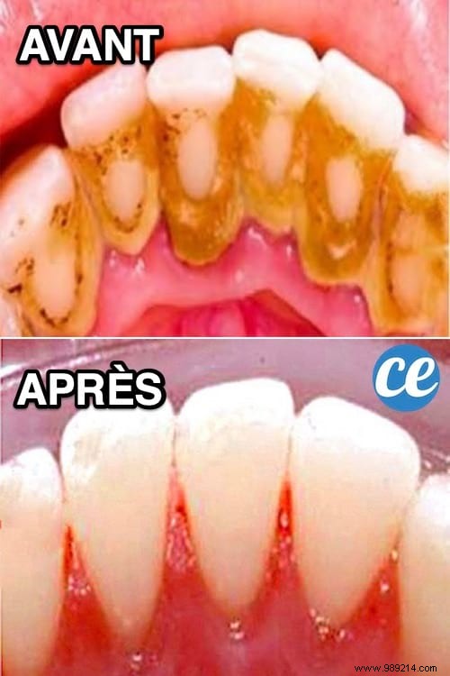 3 Proven Natural Ways to Remove Dental Tartar at Home