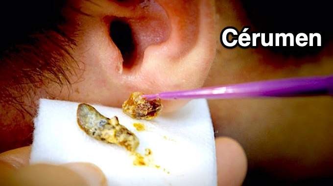 How to Safely Remove Earwax Blockage at Home: A Proven Natural Baking Soda Remedy
