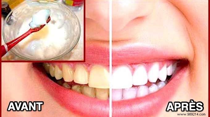 Achieve a Brighter, Snow-White Smile Naturally: My Dentist s Proven Home Remedy